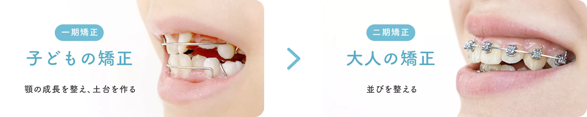 一方で、一般的な矯正治療法では…