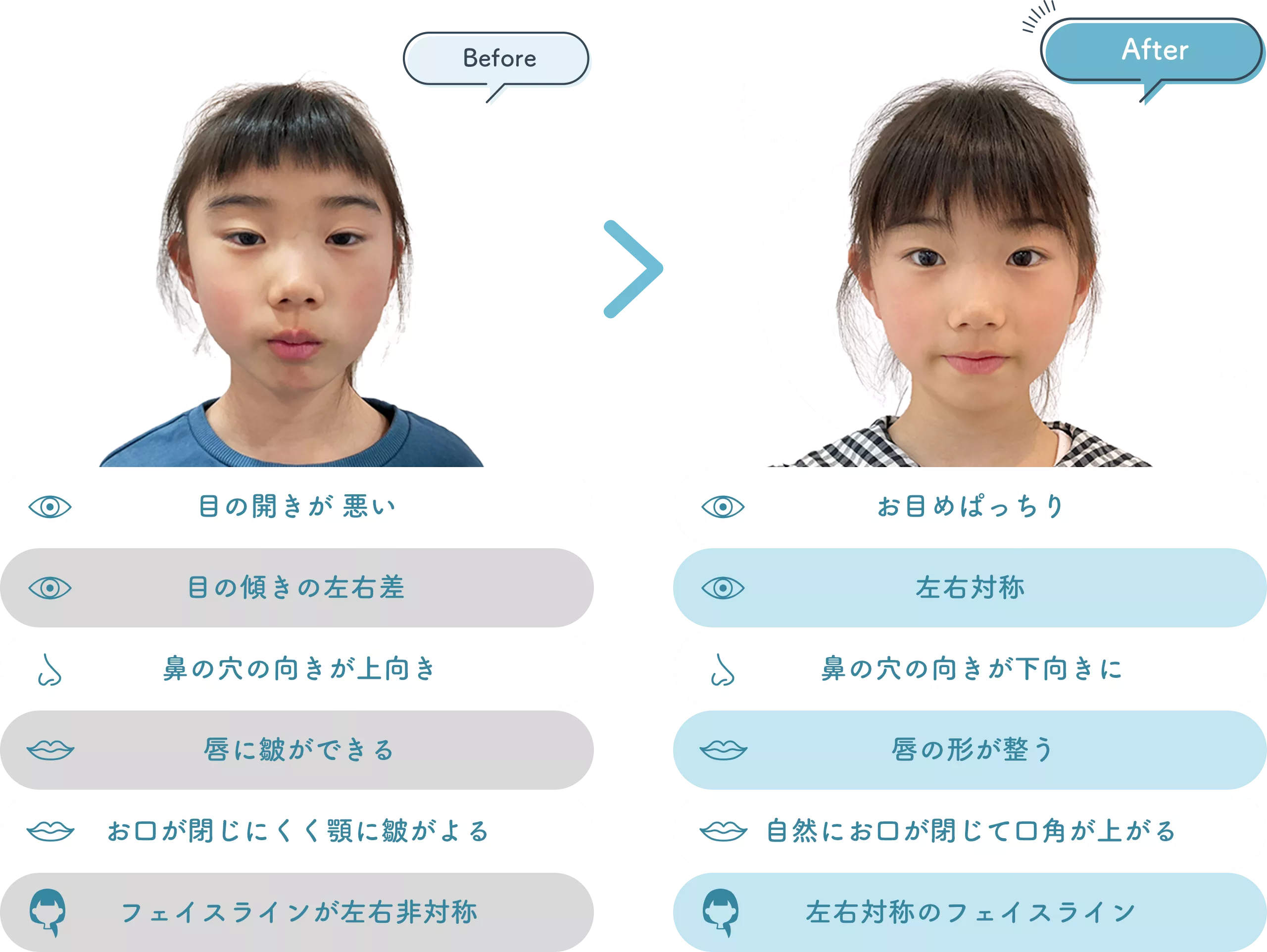 ピュアティスの矯正をはじめて1年後、お顔の表情は？